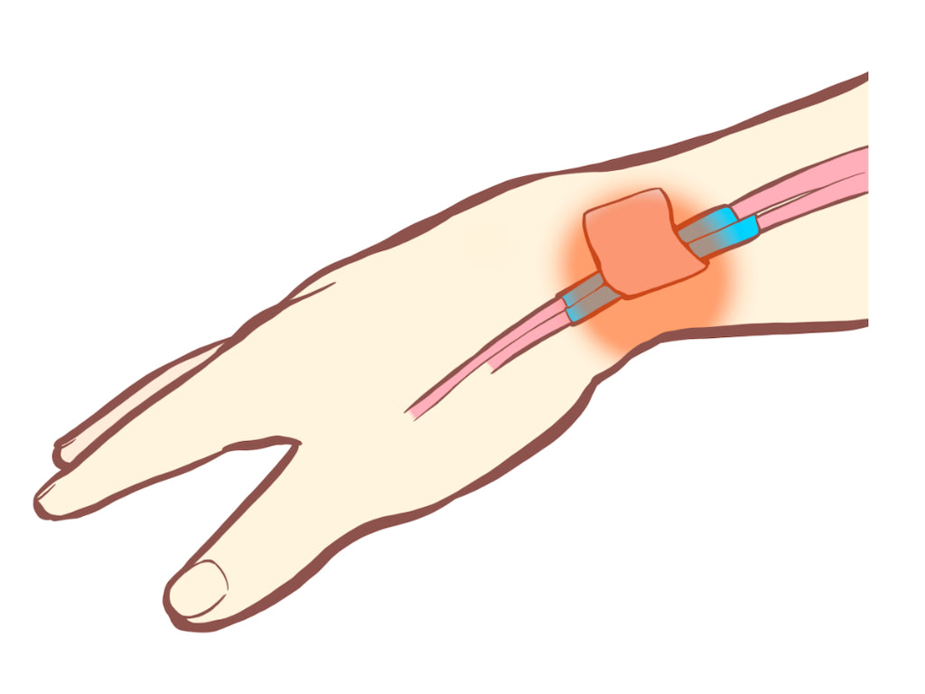 腱鞘炎は予防できるのでしょうか?